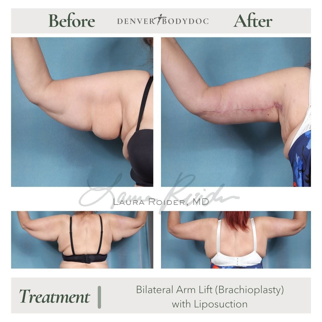 Instagram post by Dr. Nick Slenkovich: Sometimes the biggest change isn’t just what you see, it’s how freely you can move through life. A brachioplasty, or arm lift, removes exces…