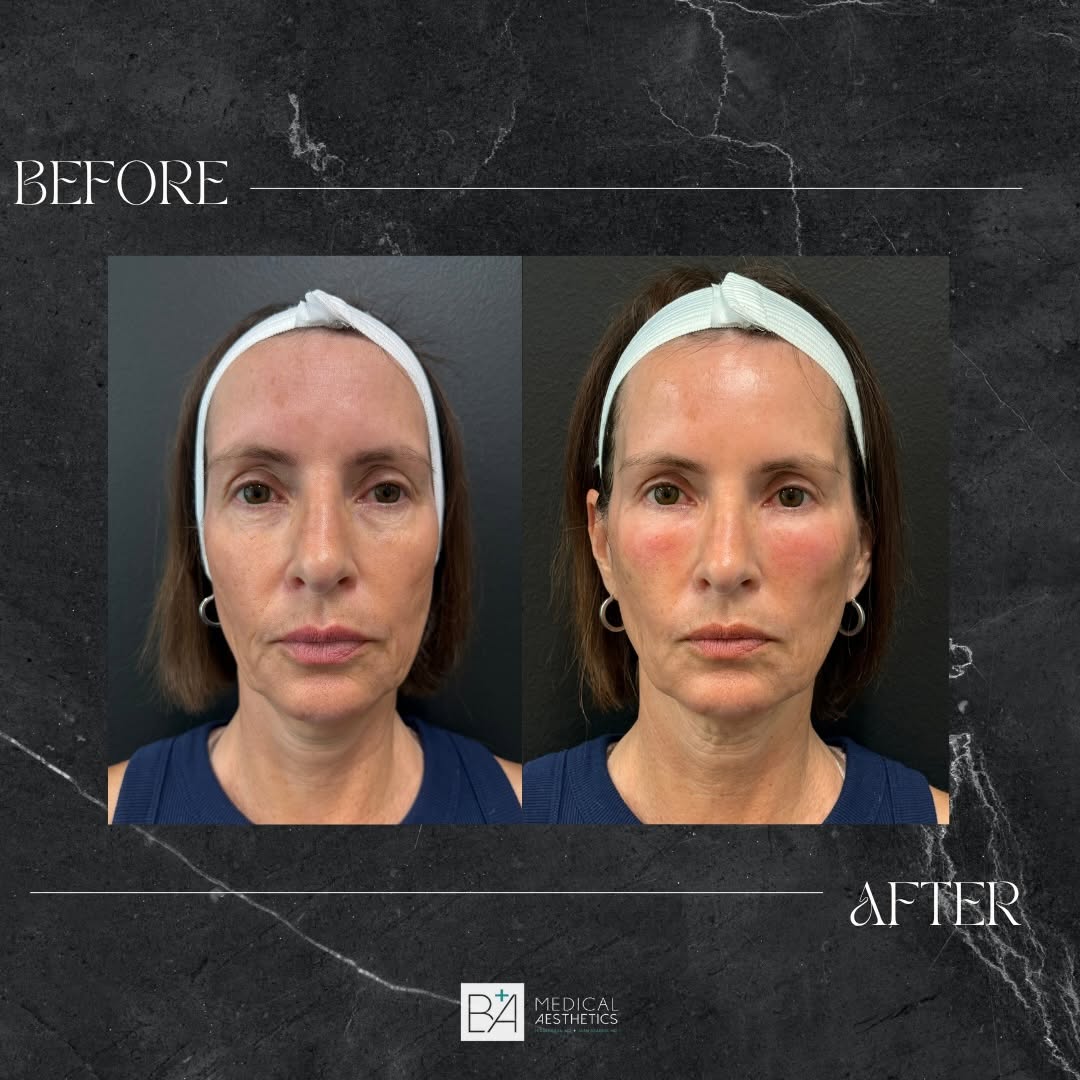 Instagram post by Dr. Nicole Basa: ✨Before & after ✨ A subtle transformation with Cellenis® Derma PRP Filler for the under-eye area Using your body’s own regenerative properti…