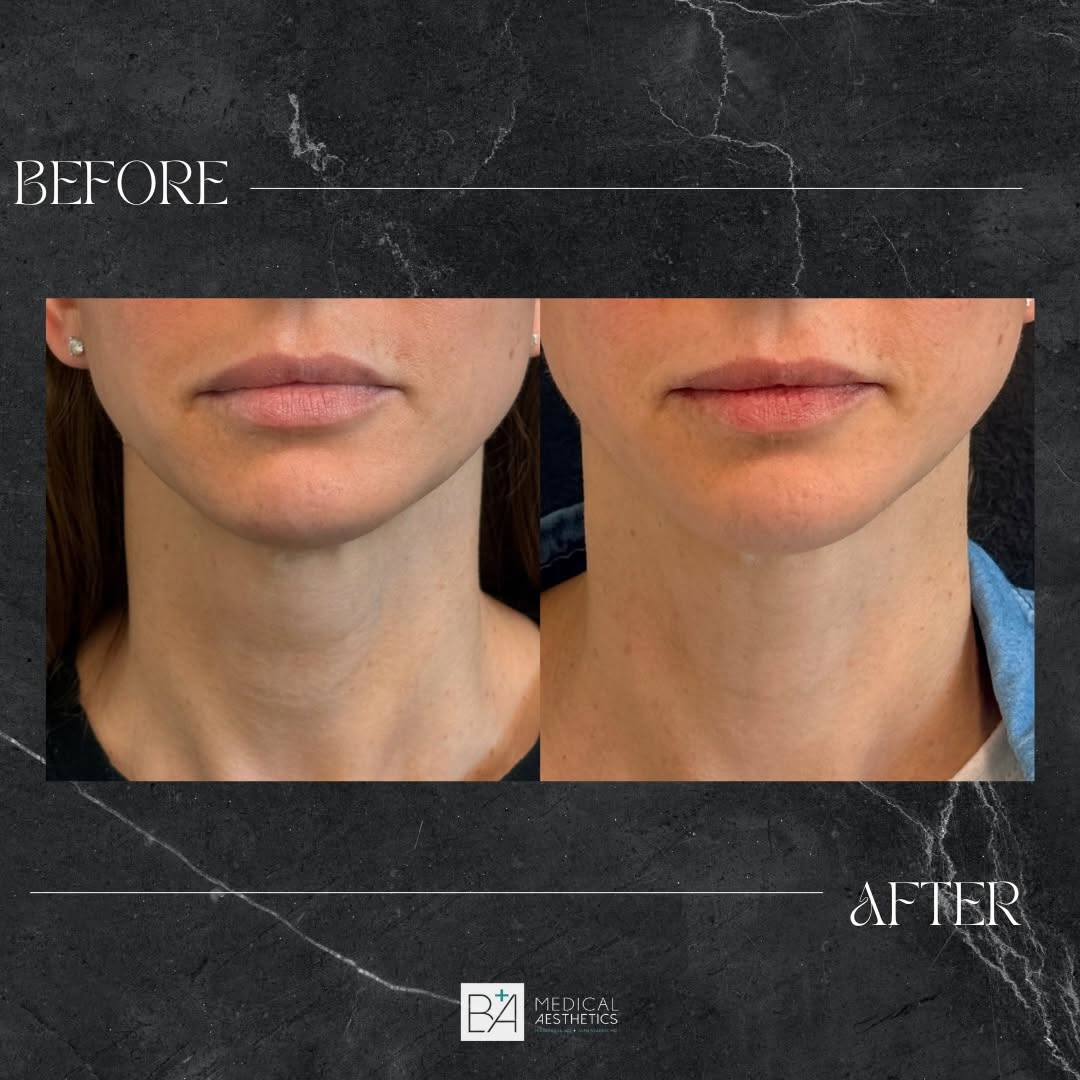 Instagram post by Dr. Nicole Basa: Before & After of ✨Gold Protocol✨ A personalized, non-surgical approach designed to tighten and define the jawline, improve the under-chin a…
