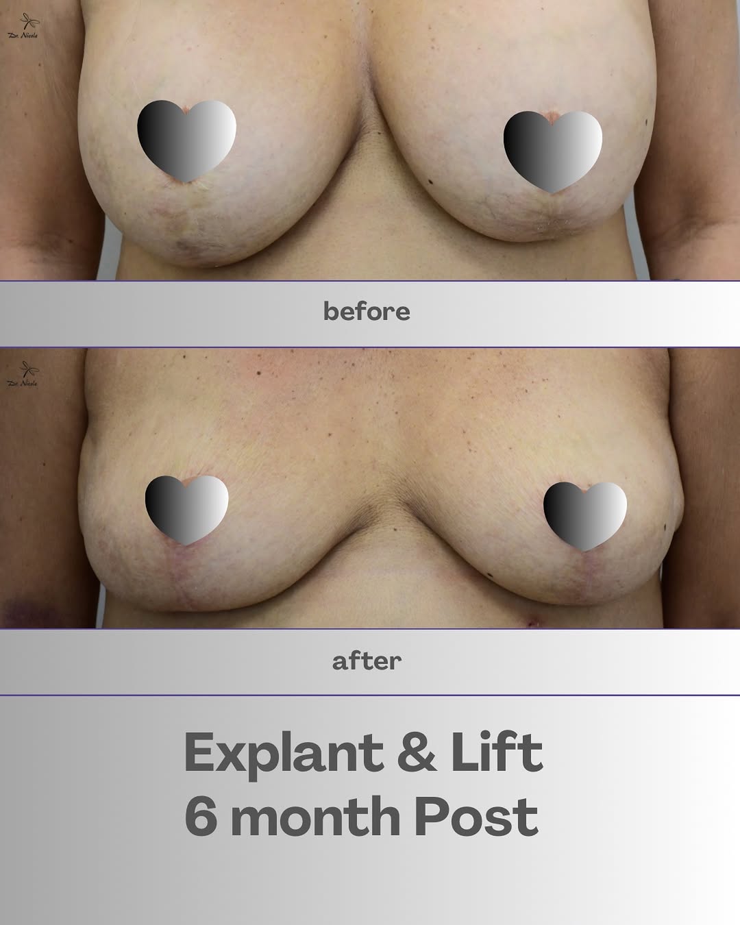 Instagram post by Dr. Nicole Castellese: Dr. Nicole is a Double Board Certified Cosmetic Surgeon, she has been in Practice since 2009. We can usually get you in for a consultation w…