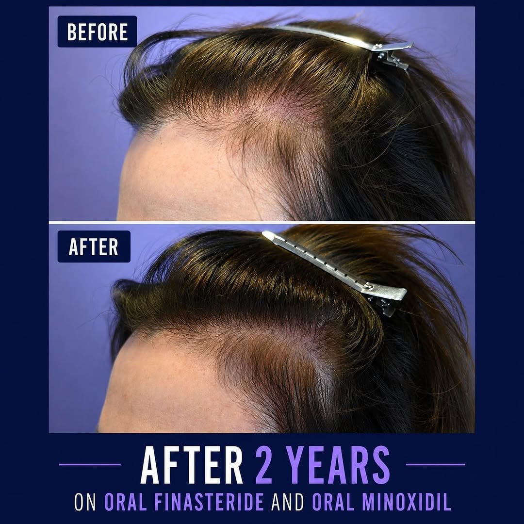 Instagram post by Dr. Nicole E. Rogers: Better living through science! #femalepatternhairloss #minoxidilhairregrowth #finasteridehairregrowth #science‼️