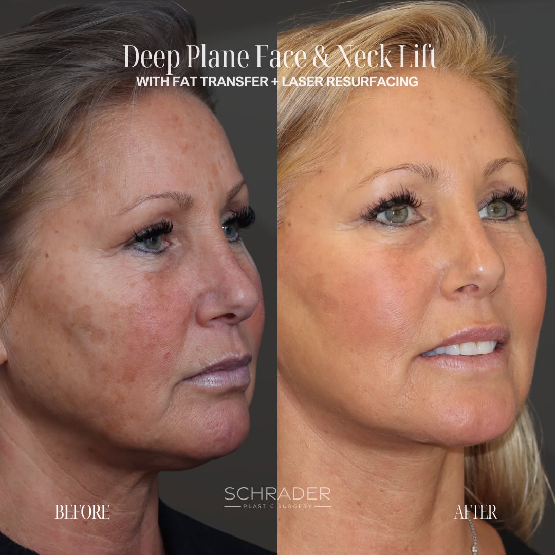 Instagram post by Dr. Nicole Schrader: This patient underwent a deep plane face and neck lift, fat transfer, and laser resurfacing to address multiple aspects of facial aging. The…
