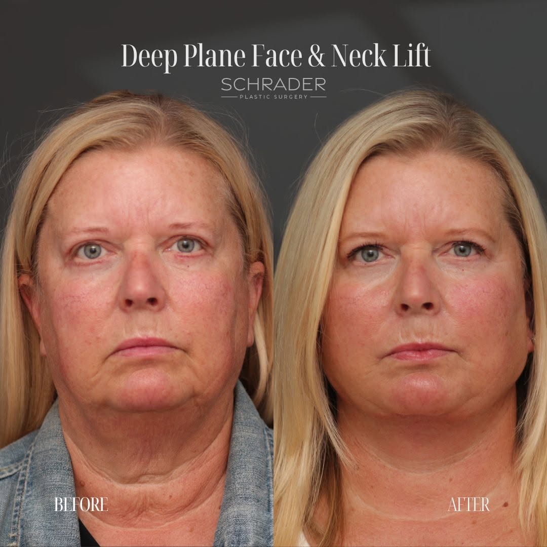 Instagram post by Dr. Nicole Schrader: Seeing a patient happy with her results is one of the most rewarding parts of facial plastic surgery. This patient wanted to address the lax…