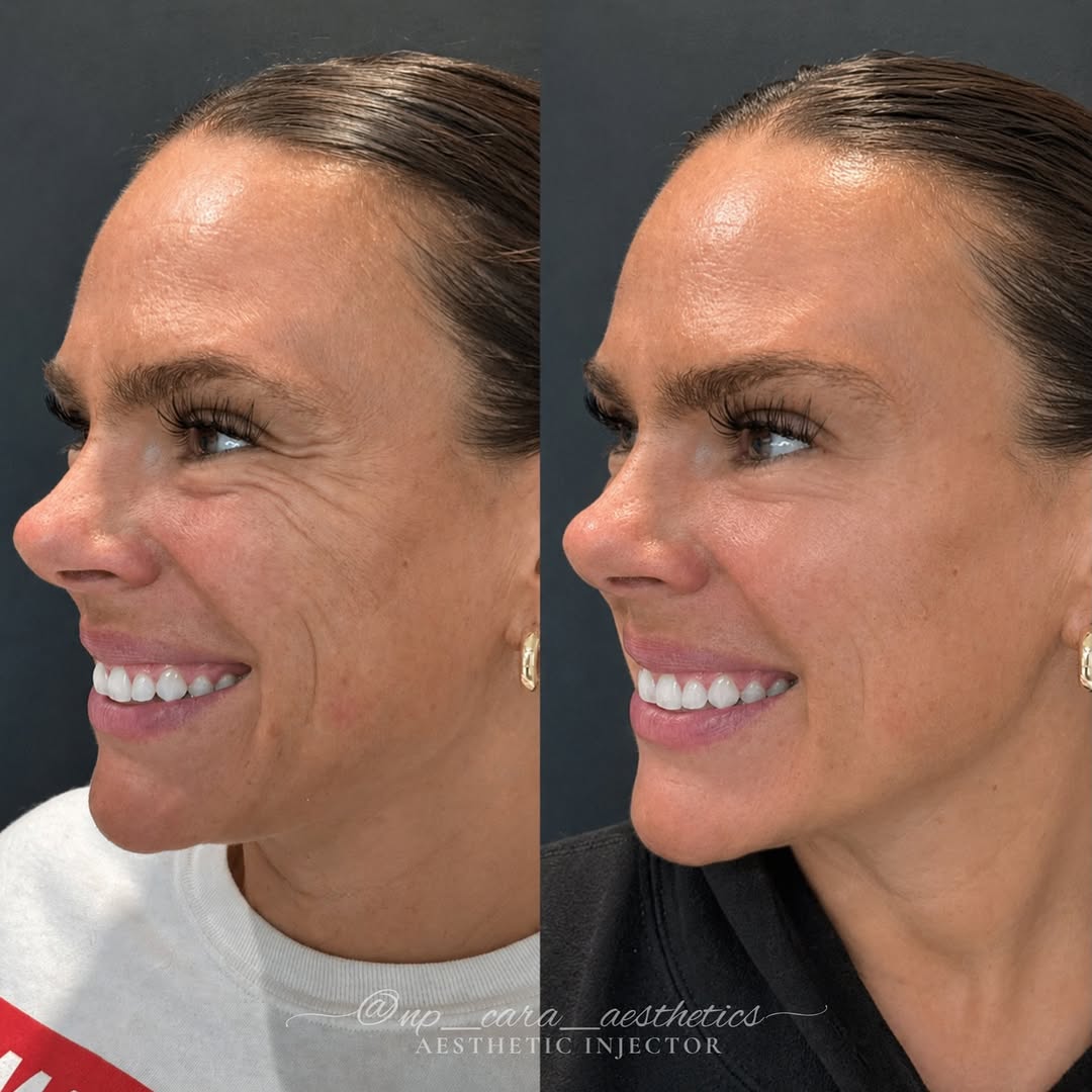Instagram post by Dr. Nina Deep: Sometimes, starting small is the best place to start. ✨ This was her very first aesthetic treatment, and like so many first-time patients, s…