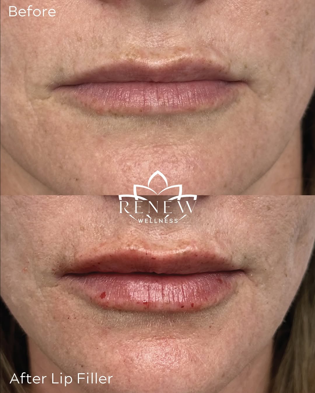 Instagram post by Dr. Nina G. Desai: This is what subtle done right looks like. Mani at our Cinco Ranch location just gave this gorgeous patient the most natural lip enhancement…