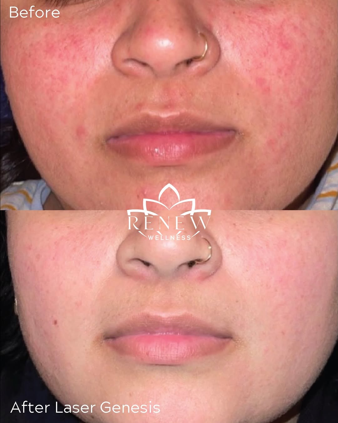Instagram post by Dr. Nina G. Desai: Rosacea, meet Laser Genesis. Calms redness. Builds collagen. Smooths texture. Zero downtime. This month it’s part of our September Glow Pack…
