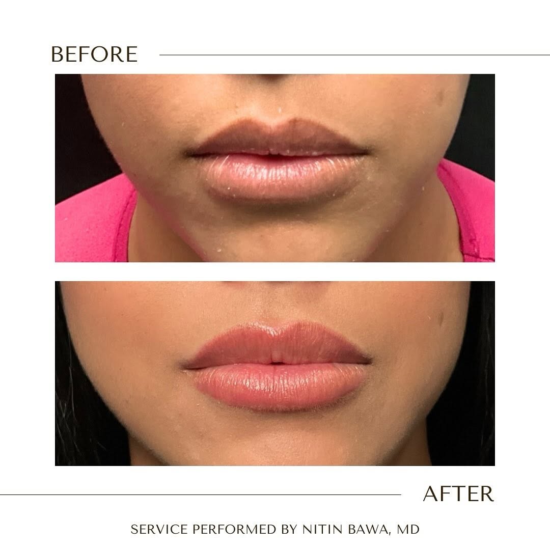 Instagram post by Dr. Nitin Bawa: 👄✨ Transform your lips with a subtle yet stunning enhancement! This beautiful lip filler treatment was done at Sei Bellissima Med Spa, wher…
