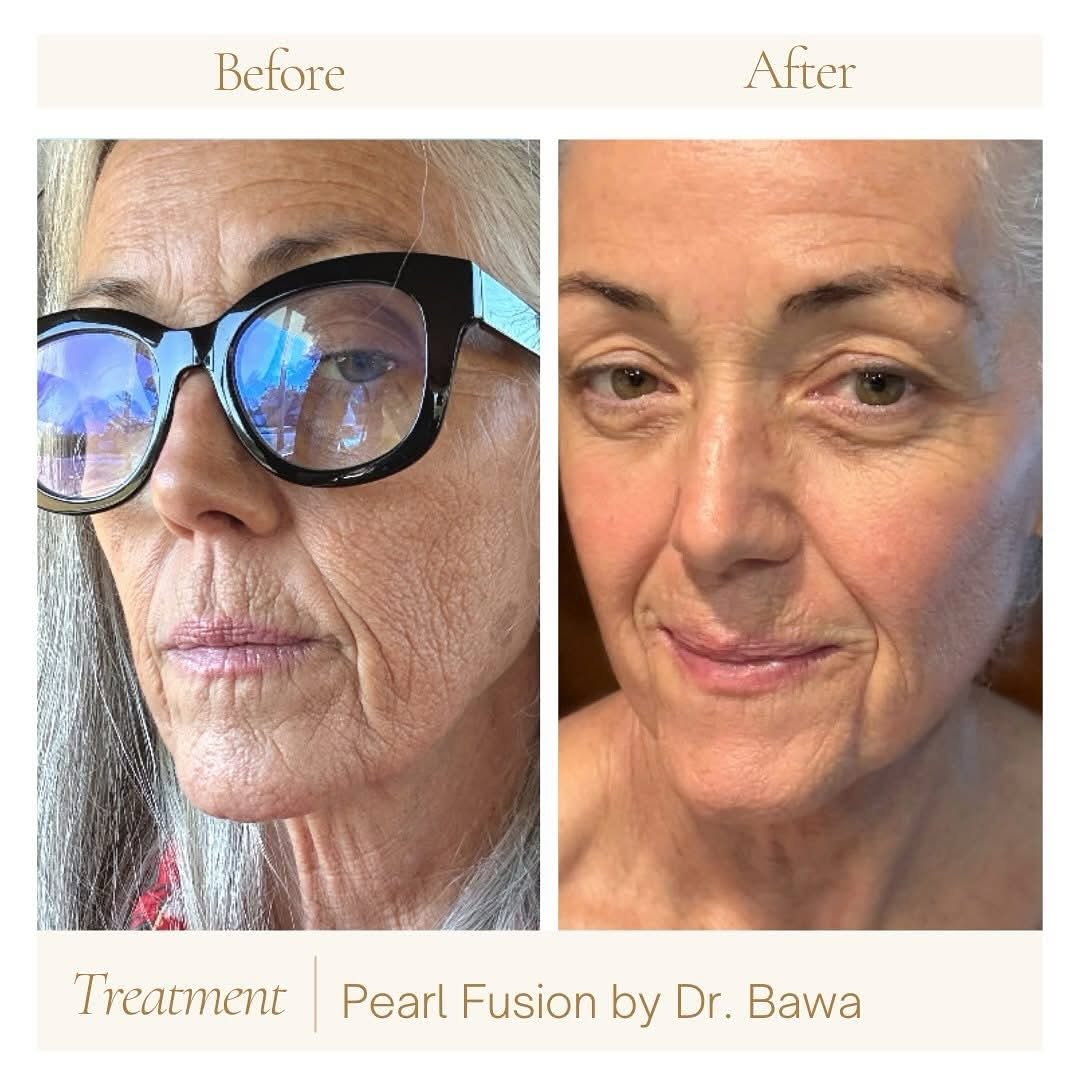 Instagram post by Dr. Nitin Bawa: 🌟 Reveal Radiance with Pearl Fusion Laser! 🌟 ✨ Say goodbye to fine lines, dull skin, and uneven texture! Experience the magic of Pearl Fus…