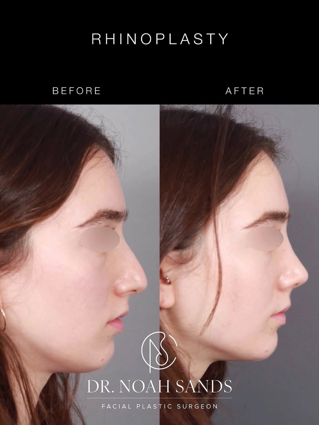 Instagram post by Dr. Noah B. Sands: A beautiful transformation… correcting her deviated nose and prominent dorsal hump to create a more balanced, refined profile. 🏠 450 N Roxb…
