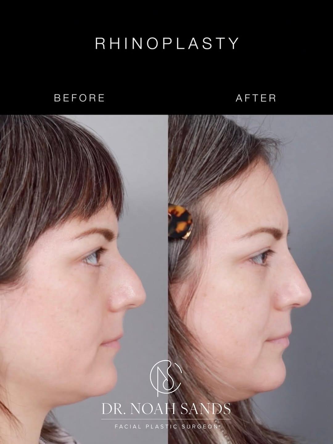 Instagram post by Dr. Noah B. Sands: Rhinoplasty for this beautiful patient. A refined profile, improved harmony, and a result that complements her features. 🏠 450 N Roxbury Dr…