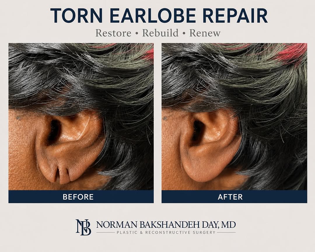 Instagram post by Dr. Norman Bakshandeh Day: Before and After Torn Earlobe Repair by Dr. Norman Bakshandeh Day To schedule an appointment please call 📞 Brooklyn: (718) 246 0130 📱Manha…