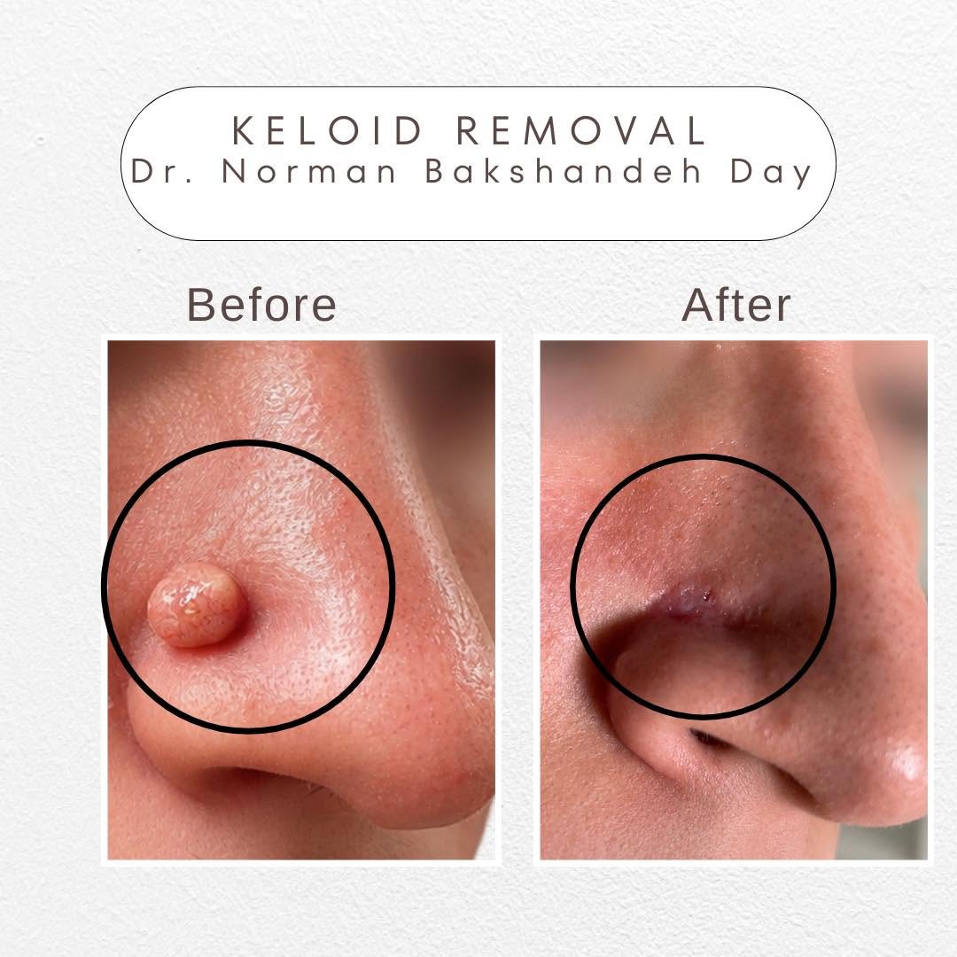 Instagram post by Dr. Norman Bakshandeh Day: Keloid Removal Before & After A small area can make a big difference in how you feel about your appearance. This before and after shows the …