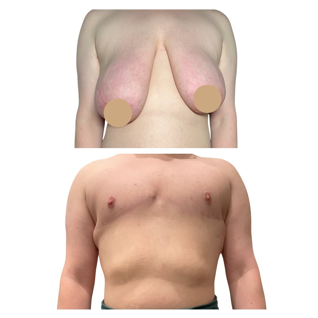 Instagram post by Dr. Nour Abboushi: Top surgery transformation ❤️ Creating a flatter, more masculine chest with results tailored to each patient’s body and goals. Every journey…