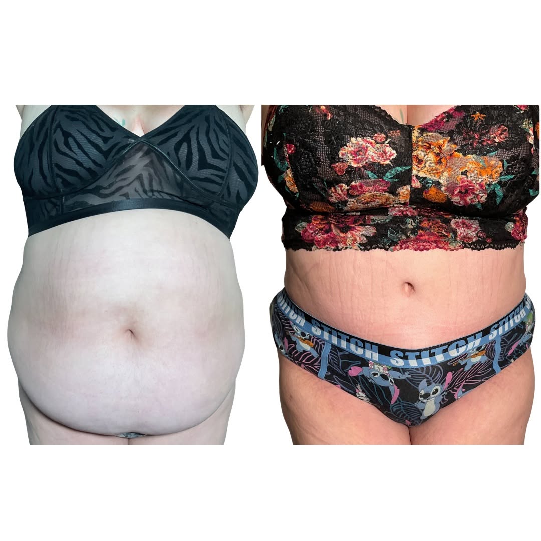 Instagram post by Dr. Nour Abboushi: A transformation worth celebrating ✨ A flatter, more defined abdomen with results that speak for themselves. Every patient’s journey is uniq…