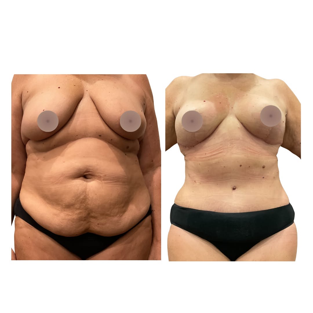 Instagram post by Dr. Nour Abboushi: One month post-op Mommy Makeover ✨ A beautiful transformation already! This Mommy Makeover helped create a flatter, more defined midsection …