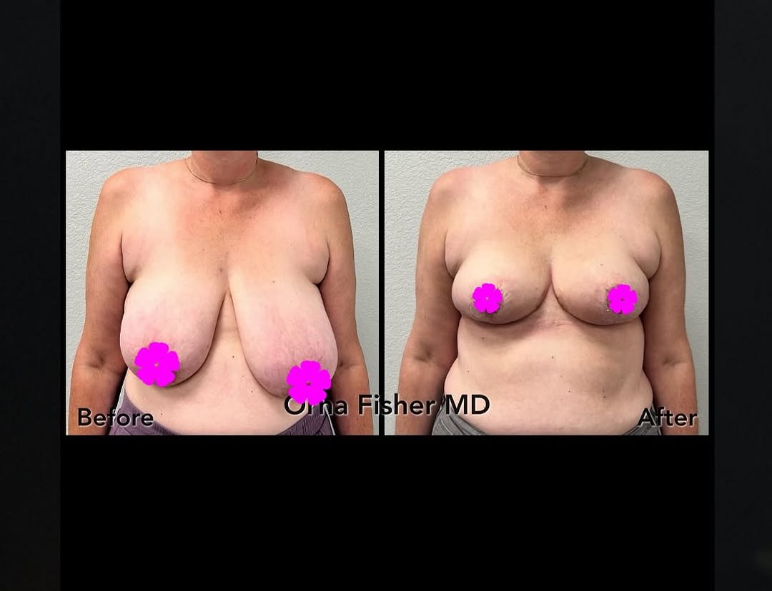 Instagram post by Dr. Orna Fisher: Love doing breast reductions, so life-changing! #breastsurgery #plasticsurgery #plasticsurgeon #bodytransformation #loveyourself #realpeople…