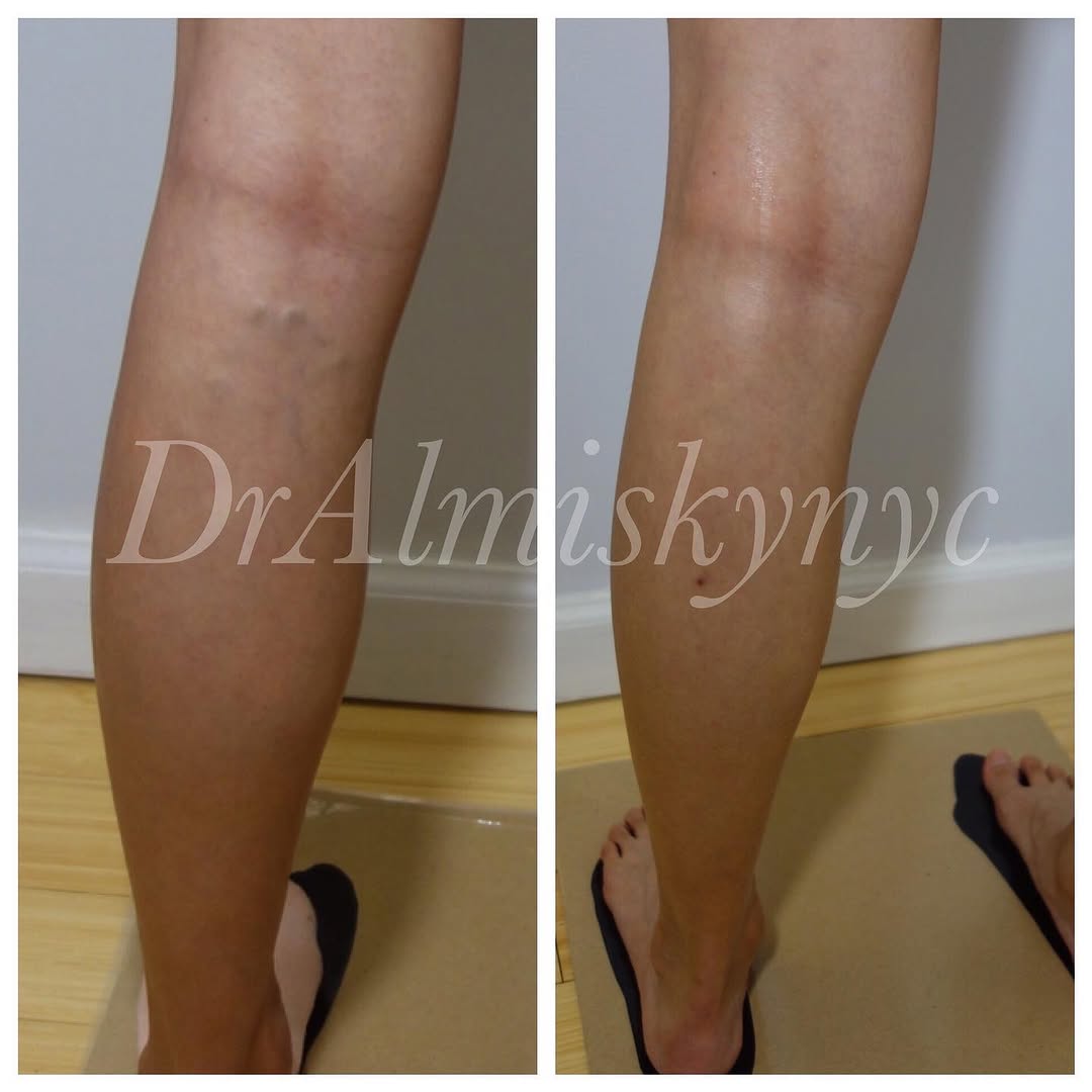Instagram post by Dr. Ousaima Al-Misky: Varicose vein ablation Treatment: #ablationprocedure To see me as a patient in my New York City private practice , please contact my office.…