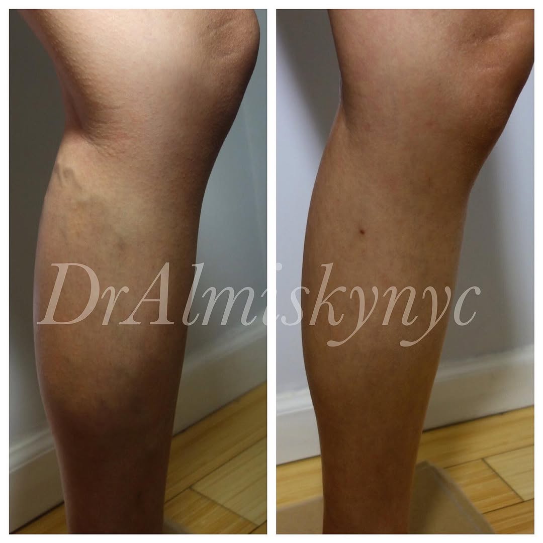 Instagram post by Dr. Ousaima Al-Misky: Varicose vein ablation Varicose Veins Treatment: #ablationprocedure To see me as a patient in my New York City private practice , please con…
