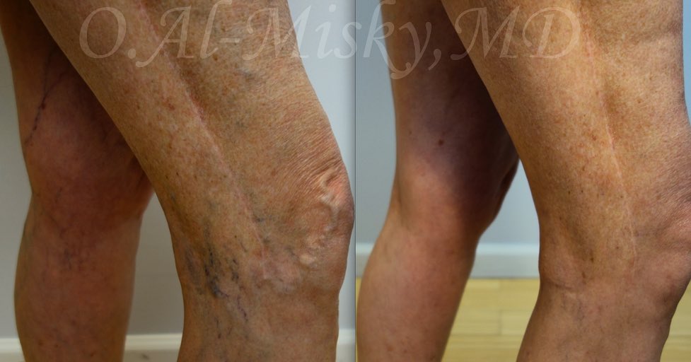 Instagram post by Dr. Ousaima Al-Misky: #varicoseveins #venasvaricosas Treatment: #sclerotherapy To see me as a patient in my New York City private practice , please contact my off…
