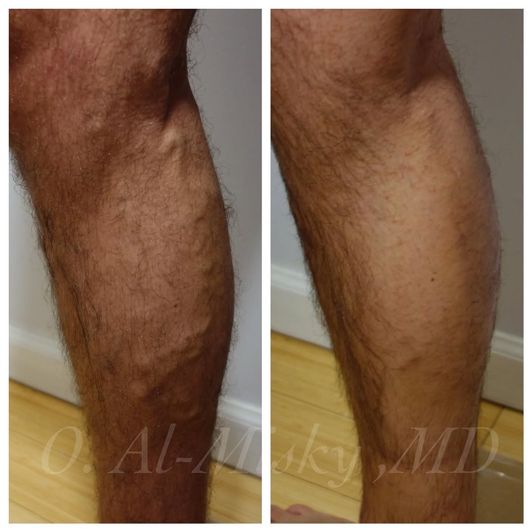 Instagram post by Dr. Ousaima Al-Misky: #varicoseveins #sclerotherapy Treatment: #veinablationsurgery To see me as a patient in my New York City private practice , please contact m…