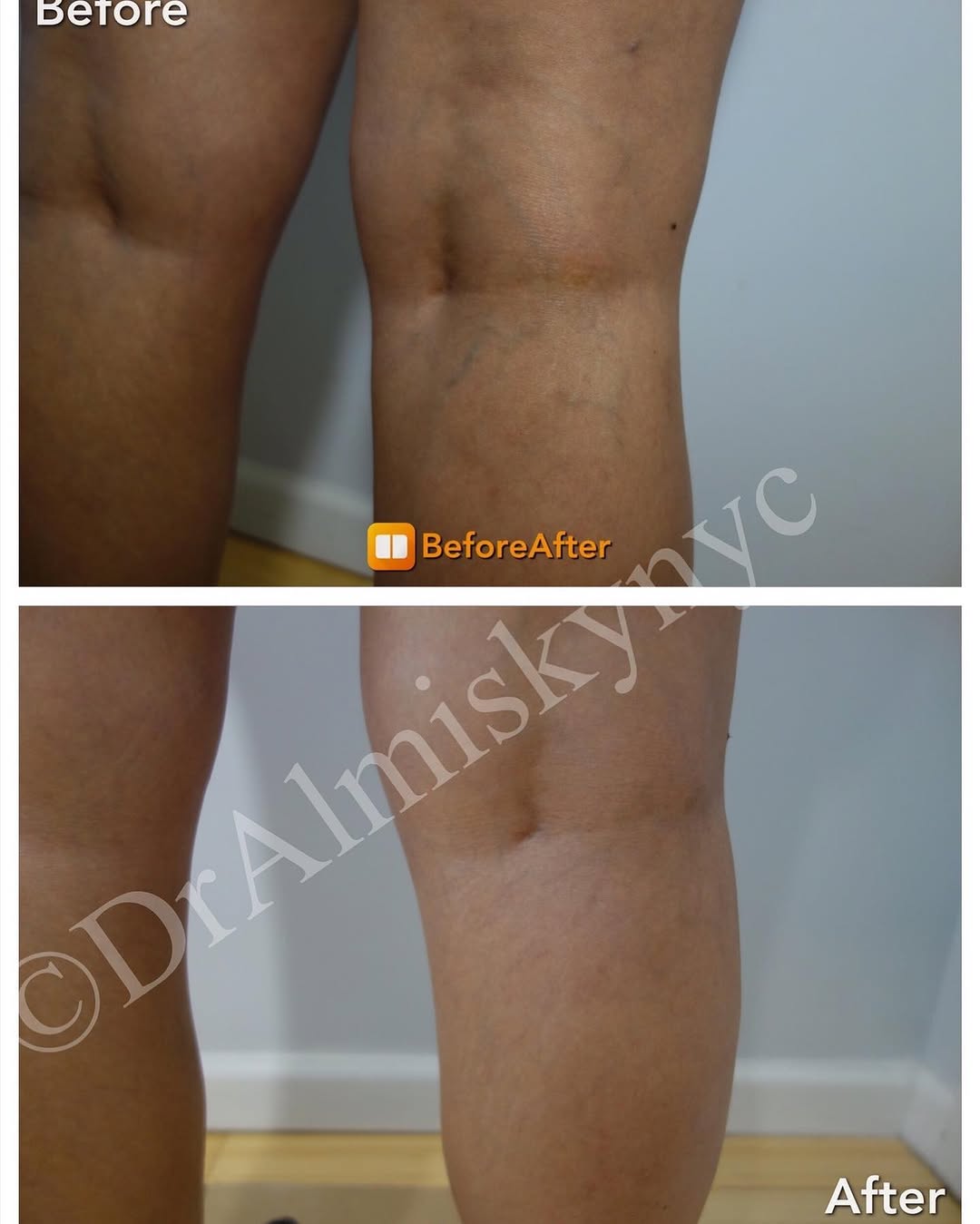 Instagram post by Dr. Ousaima Al-Misky: Now is the perfect time to work on your summer legs. Come in today for a complimentary consult! Please contact my office. ☎️212-888-8688 📧 …