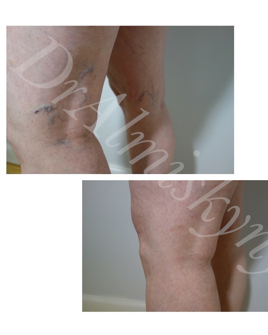 Instagram post by Dr. Ousaima Al-Misky: 49 year old female treated for spider veins with Sclerotherapy injections. To see me as a patient in my New York City private practice , ple…