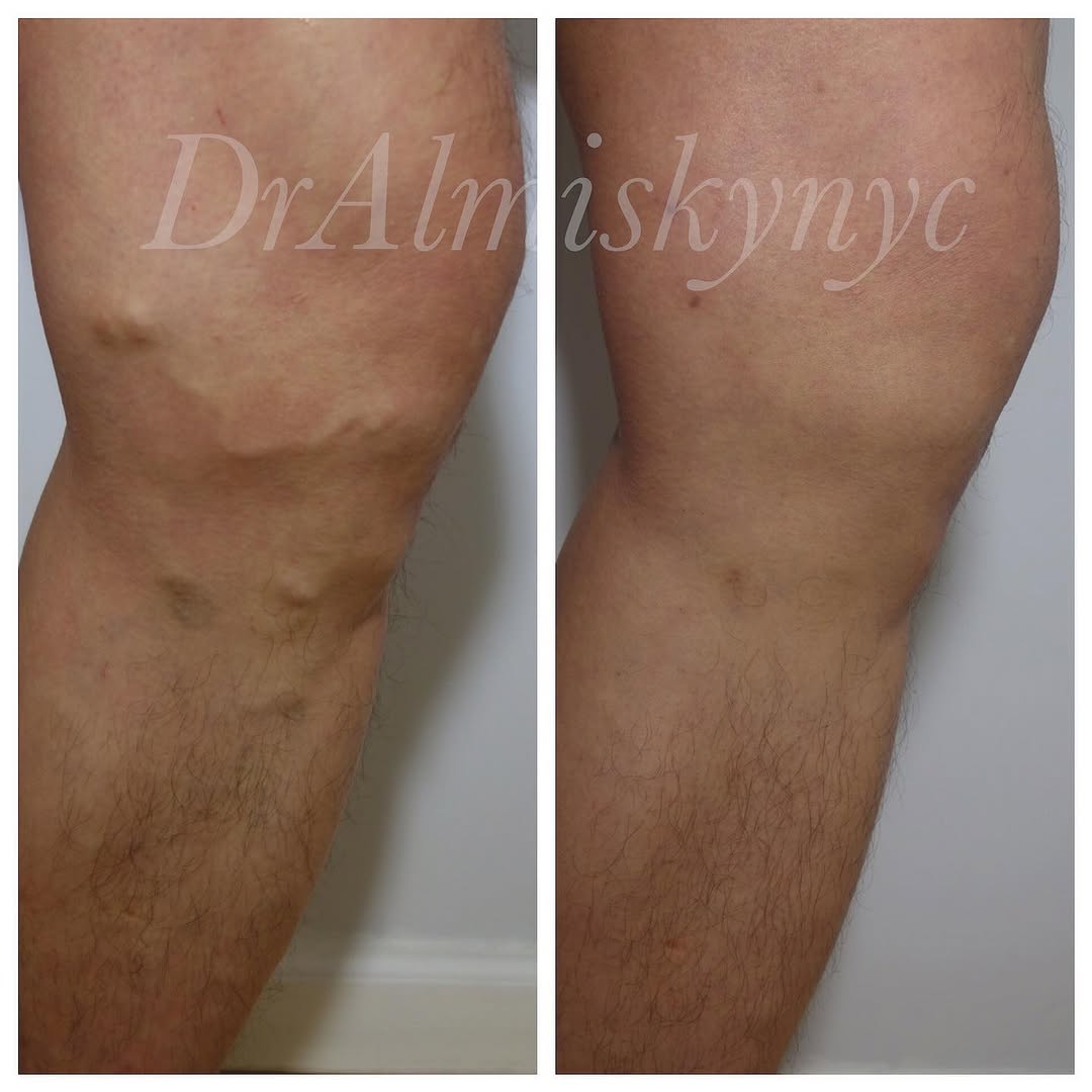 Instagram post by Dr. Ousaima Al-Misky: Varicose vein ablation Varicose Veins Treatment: #ablationprocedure To see me as a patient in my New York City private practice , please con…
