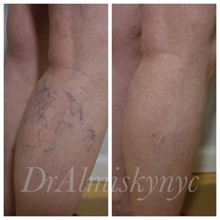 Instagram post by Dr. Ousaima Al-Misky: Winter is the perfect time to get your legs ready for summer , come in today to get your legs beach ready! Treatment: #sclerotherapy 💉 To s…