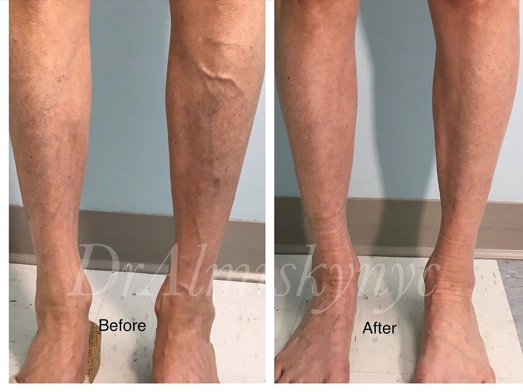 Instagram post by Dr. Ousaima Al-Misky: 56 year old female treated for varicose veins with vein ablation and Sclerotherapy injections. To see me as a patient in my New York City pr…