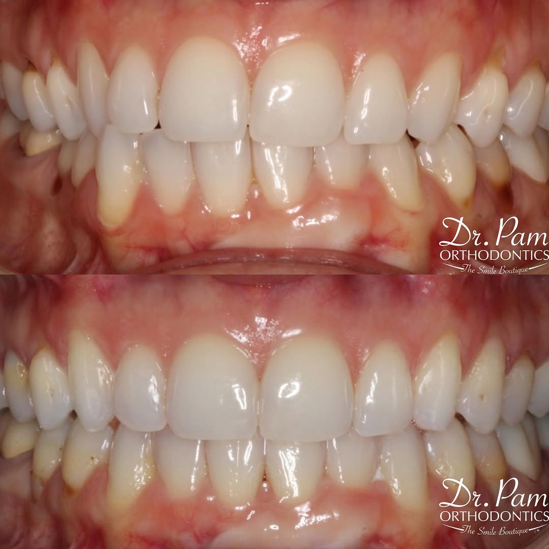 Instagram post by Dr. Pamela Steiger, D: This patient started with an extremely canted lower arch. She had prior treatment many years ago with her previous orthodontist and the loweβ¦