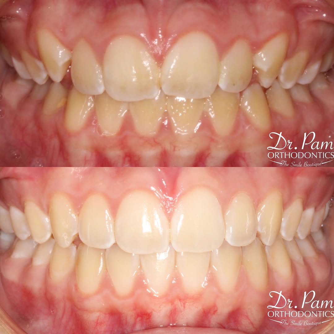 Instagram post by Dr. Pamela Steiger, D: Check out this #invisalignbydrpam before and after! π« Proper planning + excellent patient compliance = π₯ #drpam #orthodontist #invisalign β¦