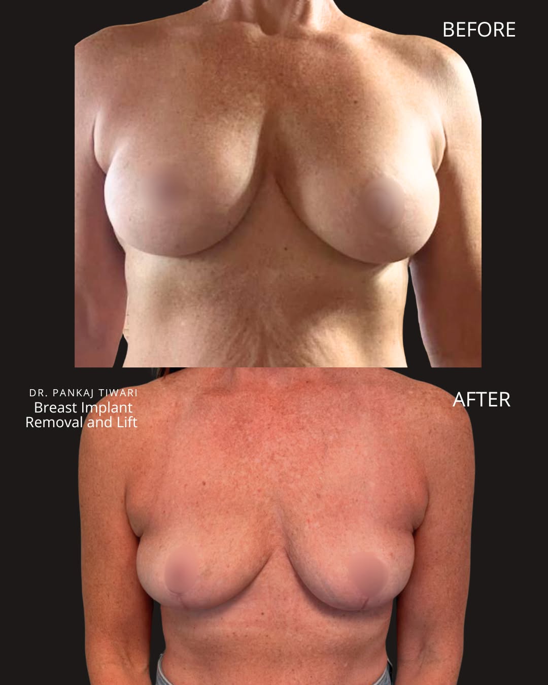 Instagram post by Dr. Pankaj Tiwari: Every woman's reason for removing her implants is different, and it's normal to worry about what's underneath. This patient in her fifties c…