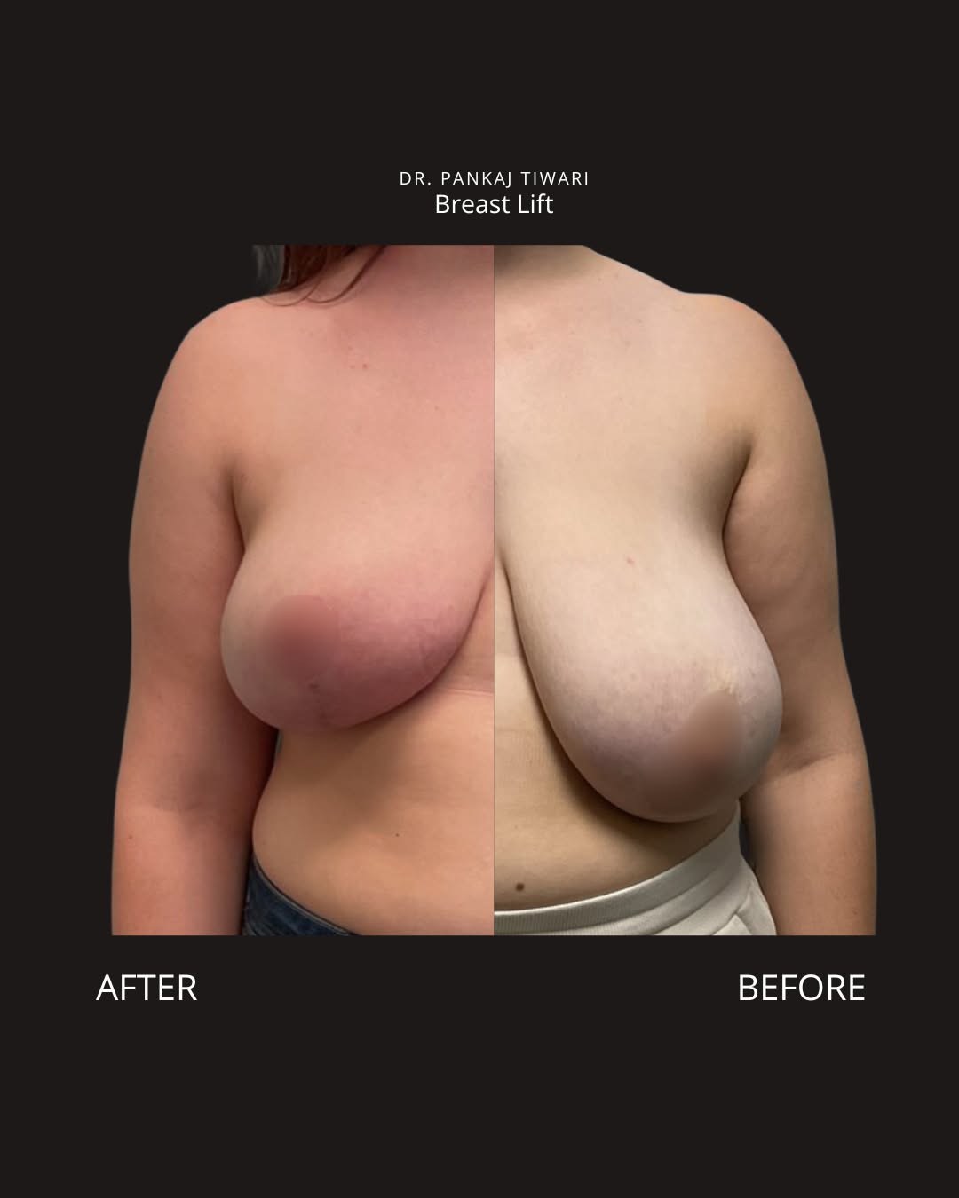 Instagram post by Dr. Pankaj Tiwari: Confidence, restored. ✨ This beautiful breast lift result by Dr. Pankaj Tiwari says it all: softer, higher, and so much more comfortable day…