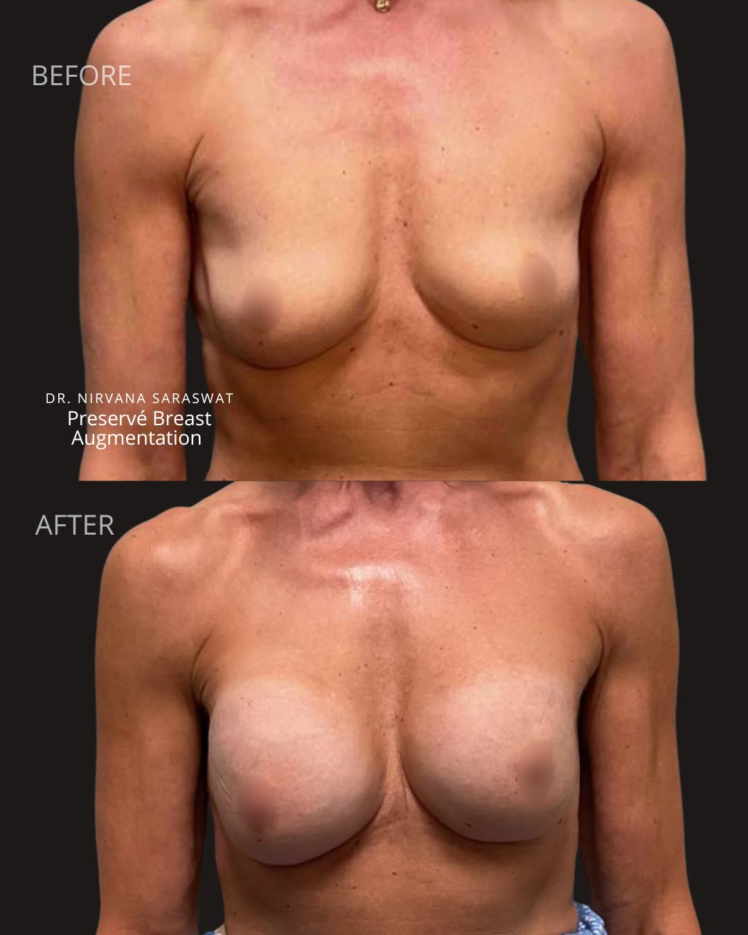 Instagram post by Dr. Pankaj Tiwari: Let's talk about Preservé.. it's not your traditional breast augmentation. Most patients are back to their normal routines quicker, and the …