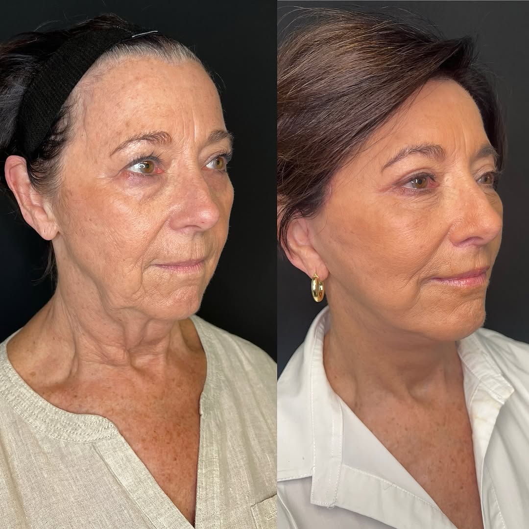 Instagram post by Dr. Parham Mafi: WOW! Just 1 Month Post-Op Full Facial Rejuvenation Can you believe this transformation?! Just 30 days after surgery and she’s glowing, snatc…