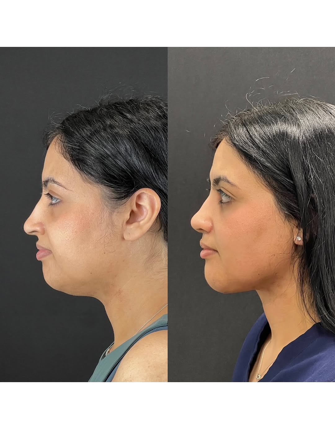 Instagram post by Dr. Parham Mafi: Only 1 month after surgery and healing beautifully. Procedures: 1. Septorhinoplasty – correct a deviated, crooked nose 2. Left buccal fat pa…