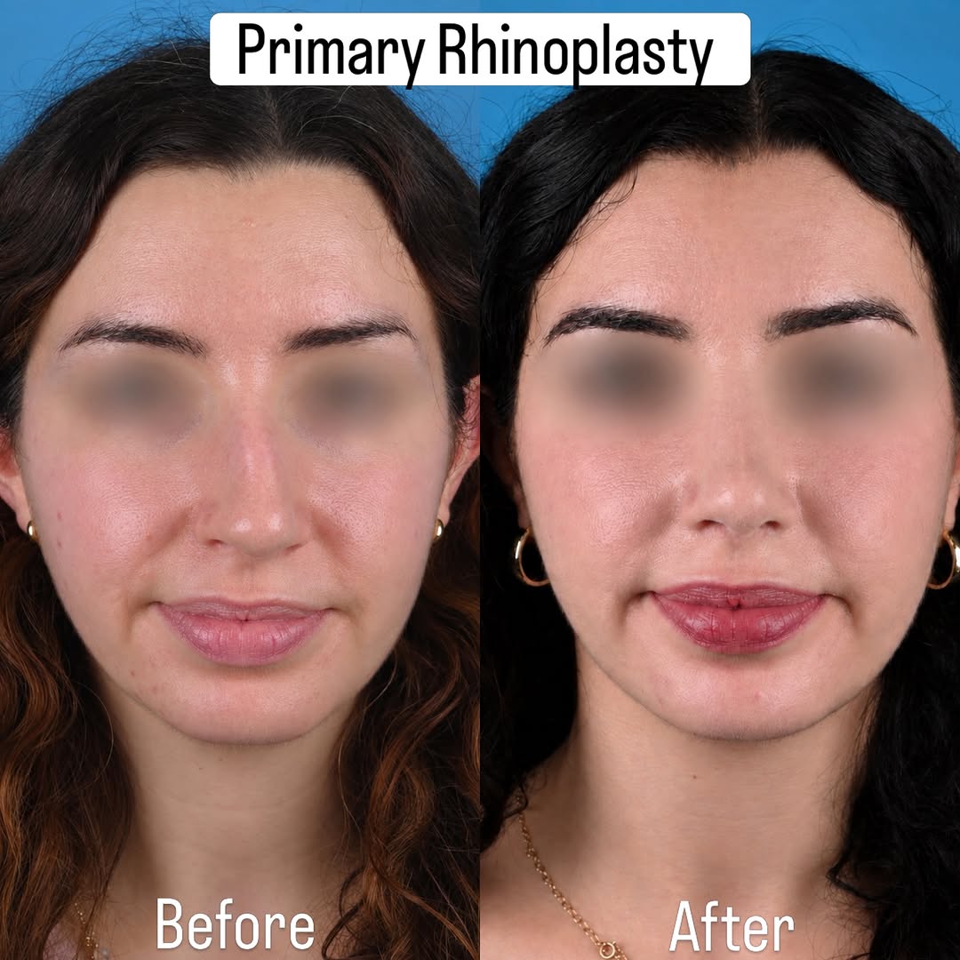 Instagram post by Dr. Parit A. Patel: Same her — just more balanced. ✨ This patient came to us wanting a straighter nose, a smoother profile, and a tip that felt lifted and refin…