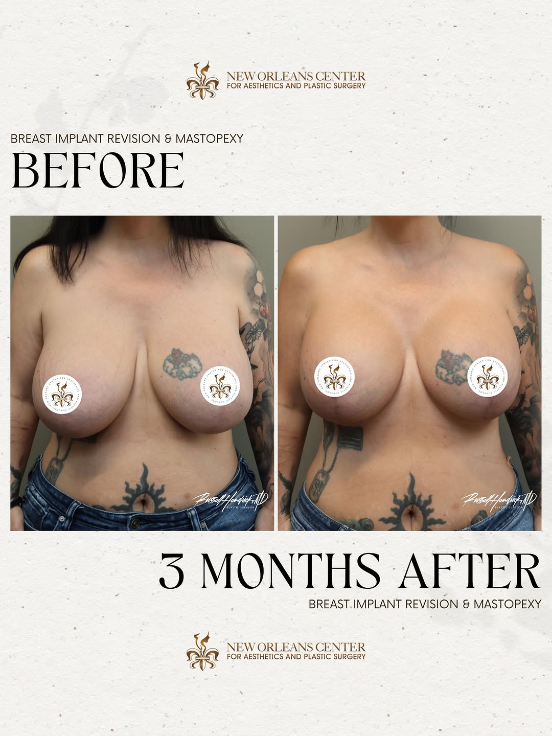 Instagram post by Dr. Parker A. Velargo: Implants aren't forever, & you don't have to live with results you don't love. A Breast Implant Revision addresses problems with existing im…