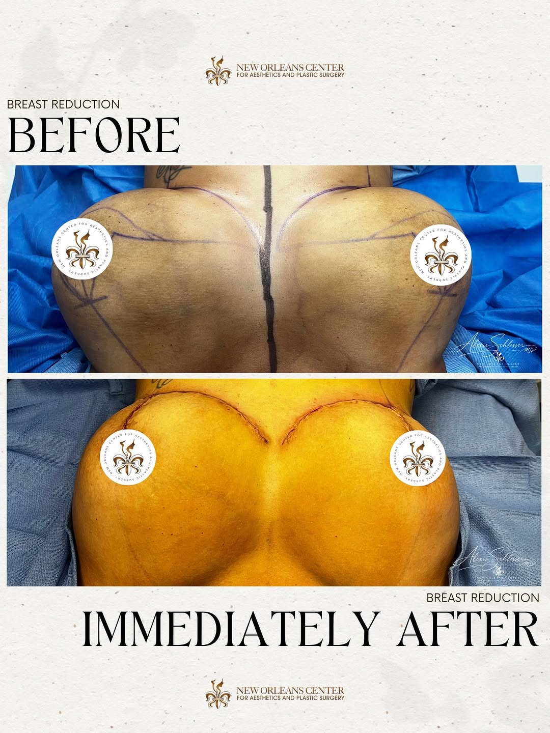 Instagram post by Dr. Parker A. Velargo: Less pain. More freedom. More comfort in your own skin. Whether you're tired of back pain, clothes not fitting right, or just don't want to …