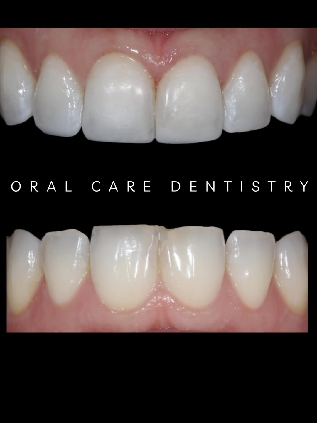 Instagram post by Dr. Parnaz Aurasteh: Composite bonding is a smiple, conservative way to repair chips and restore the natural shape. All in one visit! Transforming smiles every d…