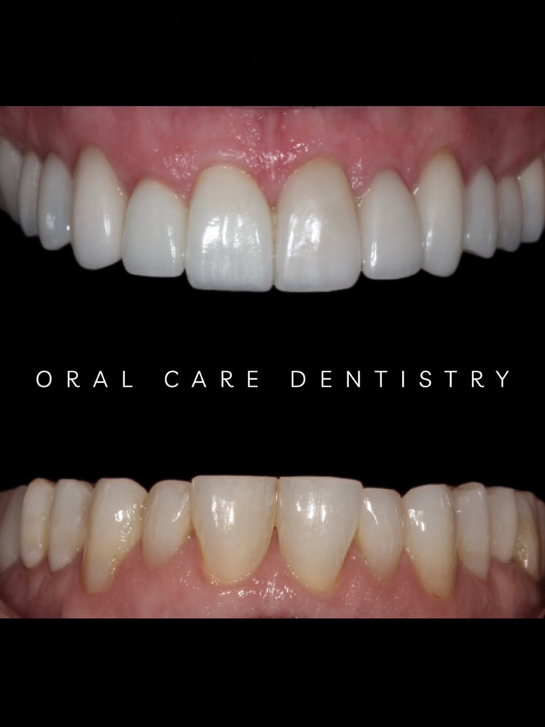 Instagram post by Dr. Parnaz Aurasteh: You can’t tell these are veneers -and that’s exactly the point🦷✨ This is what happens when precision meets artistry. At Oral Care Dentistry…
