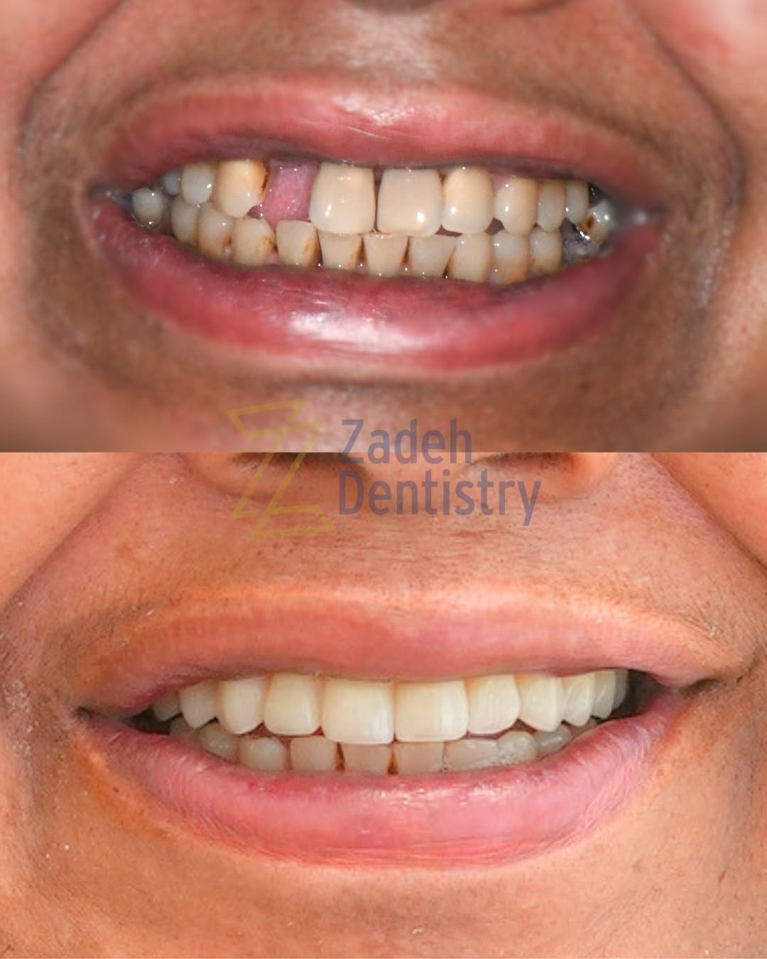 Instagram post by Dr. Parsa T. Zadeh: Heather’s journey was about more than a new smile. At first, fear and past experiences made it hard for her to fully trust the process. With…