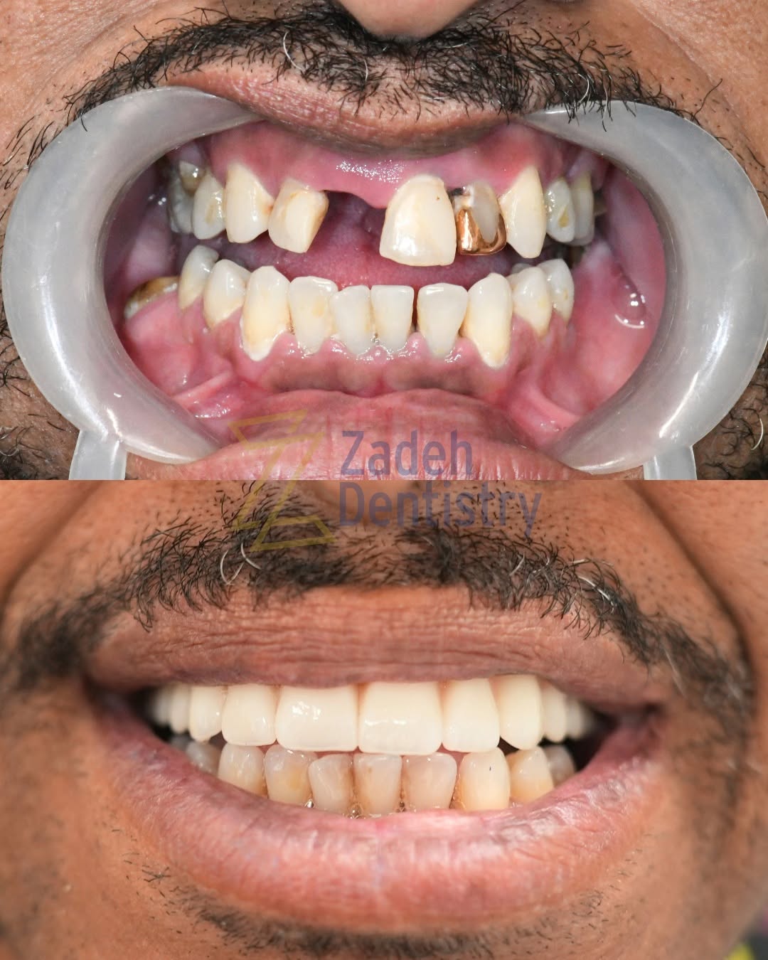 Instagram post by Dr. Parsa T. Zadeh: Kevin couldn’t wait to go home and show his wife his new smile. Dental problems can affect more than just the way we eat—they can also chang…