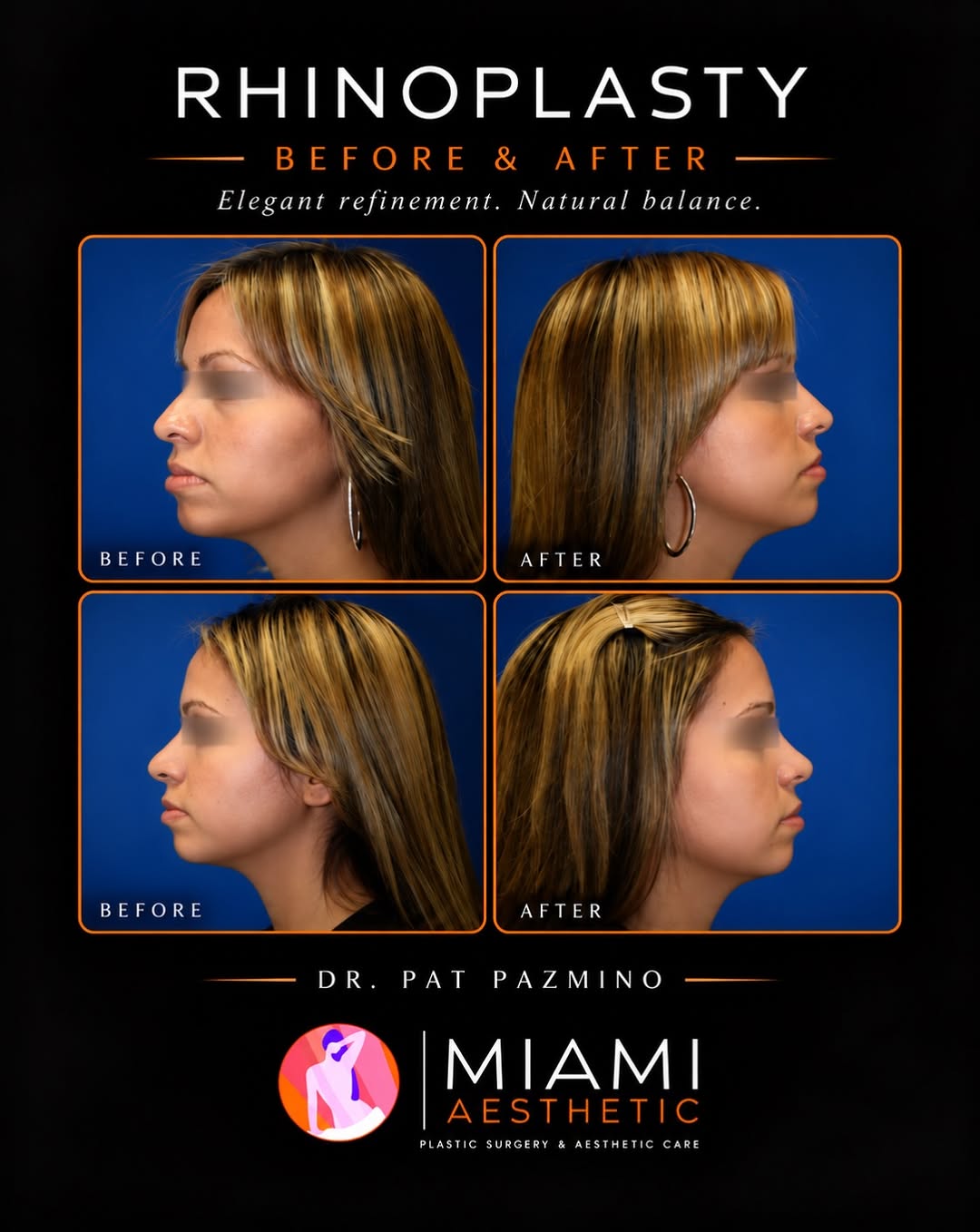 Instagram post by Dr. Pat Pazmino: Refined. Balanced. Beautifully You. ✨ Rhinoplasty is about more than changing the shape of the nose — it’s about creating better facial harm…
