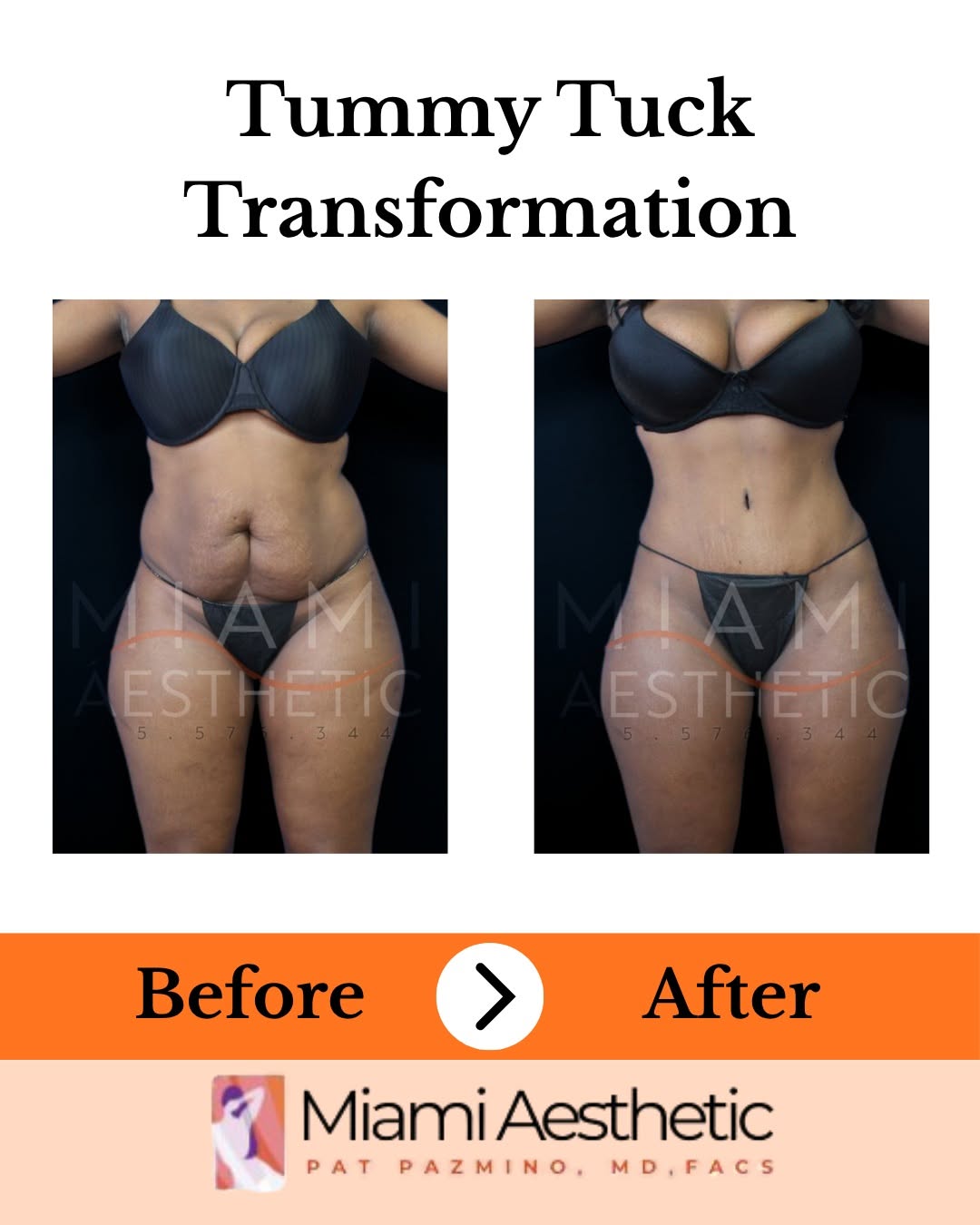 Instagram post by Dr. Pat Pazmino: ✨ A beautiful transformation, inside and out! Our tummy tuck procedure helps create a flatter, firmer, and more contoured abdominal appearan…