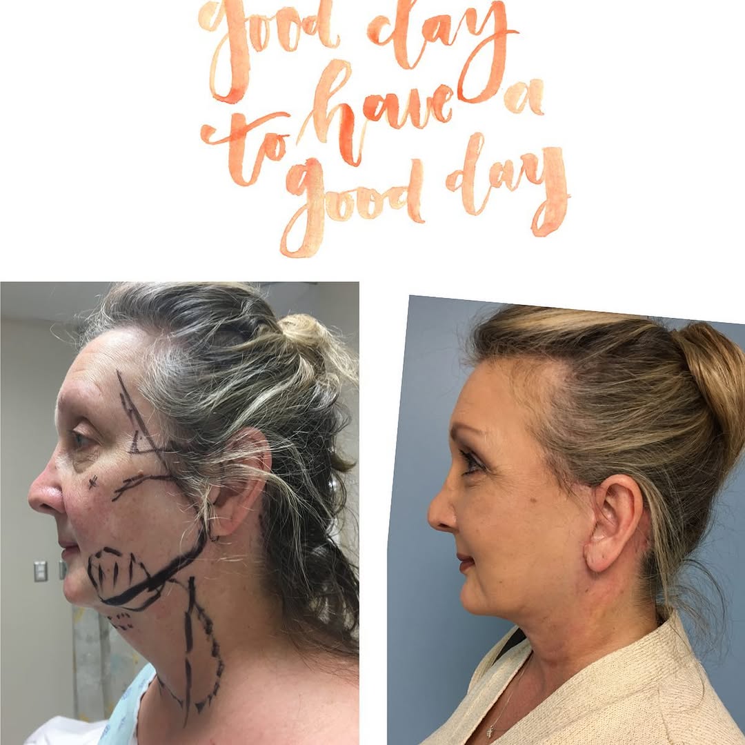 Instagram post by Dr. Patricia L. Eby: One month after Drs Aldea and Eby did my facelift and I’m loving it! #readyforchristmas #readyfor2021 #facelift #necklift @thebeautydoctors.…