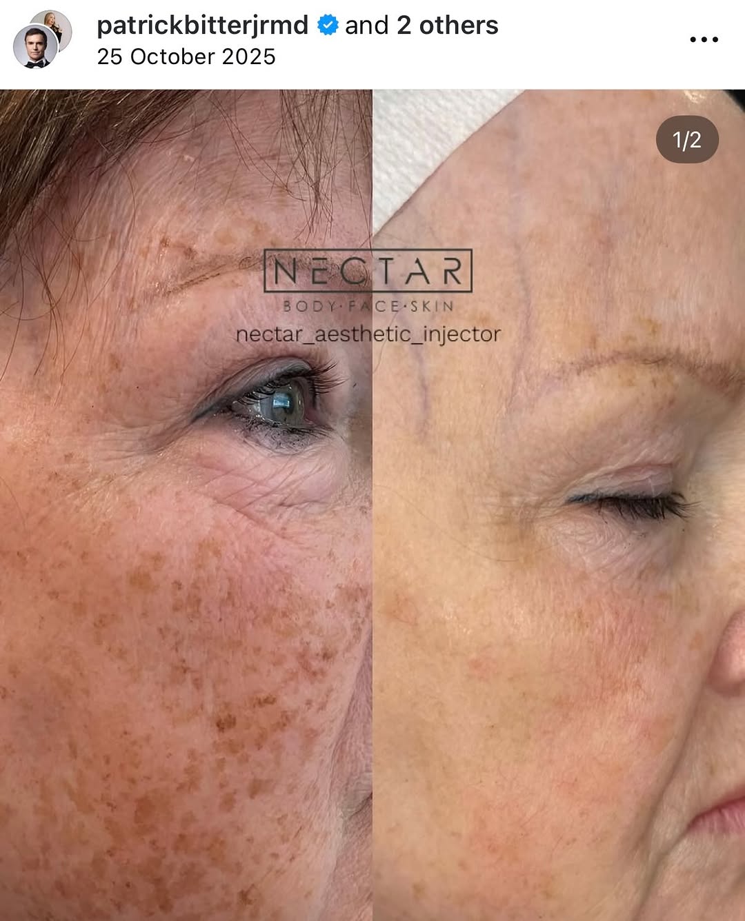 Instagram post by Dr. Patrick Bitter Jr.: ✨ Vorher-Nachher-Ergebnis nach nur zwei Behandlungen aus der Praxis von @nectarbodyfaceskin.mi an. Es zeigt was mit Sciton BBL HEROic® + Ski…