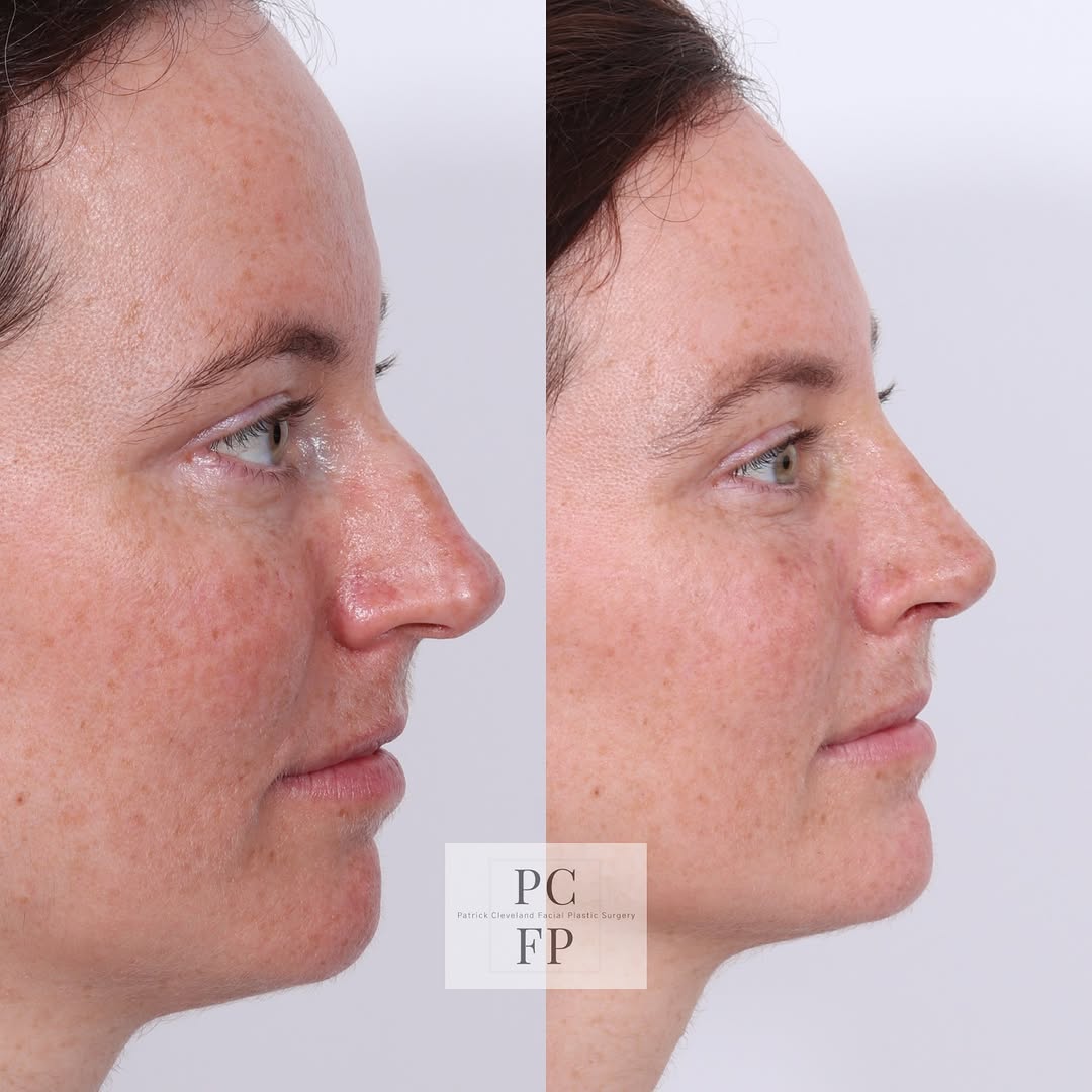 Instagram post by Dr. Patrick Cleveland: Transforming the details can make all the difference! 👃🌟 This patient’s rhinoplasty focused on refining a boxy tip, creating a softer, mor…