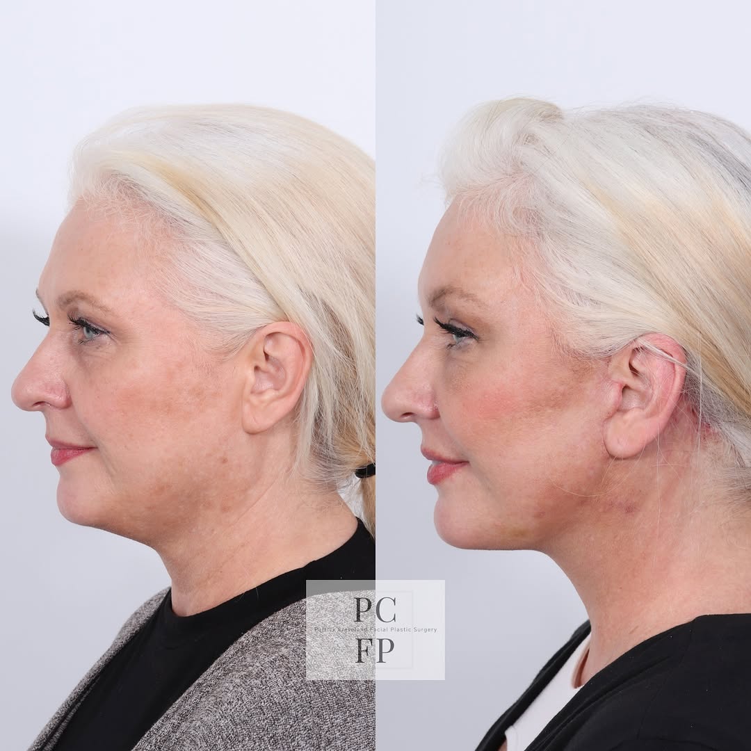 Instagram post by Dr. Patrick Cleveland: Unveiling a refreshed, natural look with the perfect blend of facelift and liposculpting! 🌟 This dynamic duo helps contour and rejuvenate b…