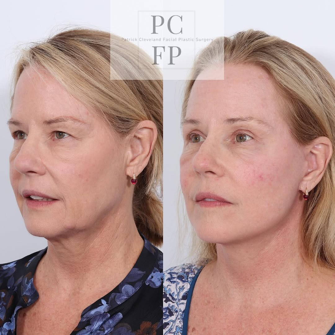 Instagram post by Dr. Patrick Cleveland: Stay tuned as we reveal our patient’s remarkable six-month facelift results and provide insight into her smooth recovery journey. This trans…